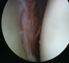 Arthroscopy Soft Tissue Bankart